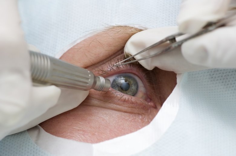 cataract surgery