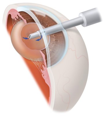 retinal detachment