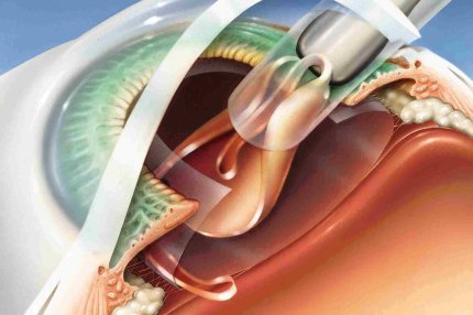 Secondary open angle glaucoma operation